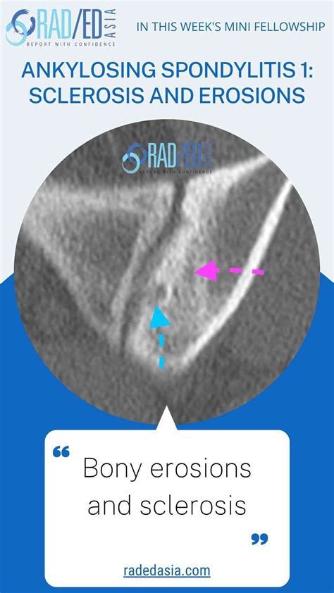 ANKYLOSING SPONDYLITIS SACROILIITIS CT CHANGES SACRO ILIAC JOINT SPINE ...