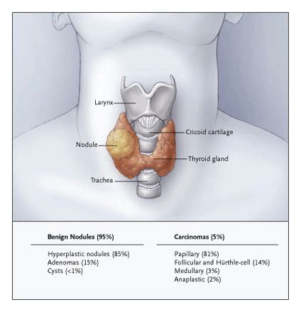 MyThyroid.com: Thyroid Nodules