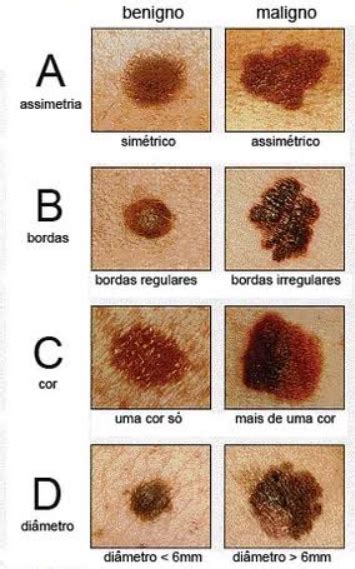 O Ano Laranja: conscientização sobre o câncer de pele – Pronto ...