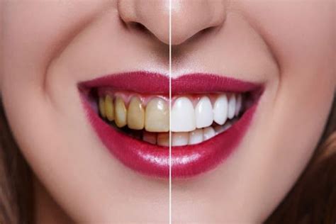 Teeth Straightening: A Highly Beneficial Treatment