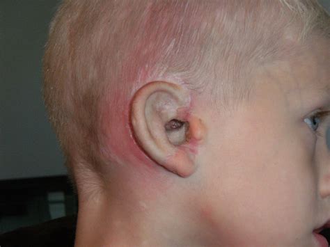 Robbies Little Nubby: Hole in Ear Drum and Another Mosquito Bite 7/11/11