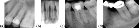 Periapical diagnosis a Pulpal necrosis with symptomatic apical ...