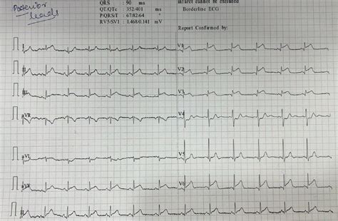 Posterior wall myocardial Infarction case - Clinic Hours