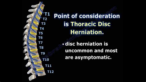 Thoracic Disc Bulge Treatment - Captions Beautiful