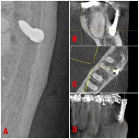 Radiographic images taken for assessing the location of buccal shelf ...