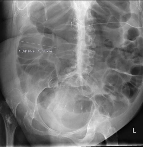 Paralytic ileus - Radiology at St. Vincent's University Hospital