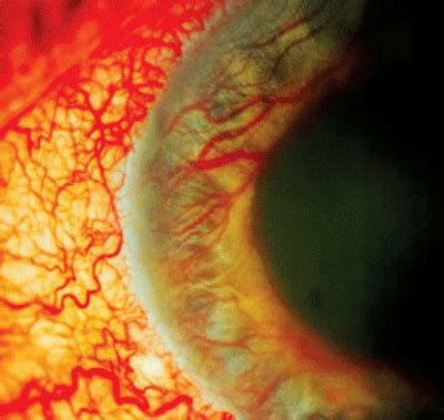 with neovascular glaucoma