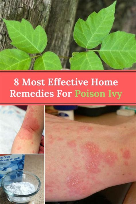 Poison Ivy Home Remedies: 8 Most Effective Remedies For Poison Ivy ...