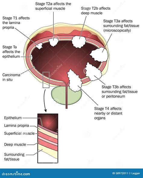 Staging of bladder cancer stock vector. Illustration of cancer - 58972011