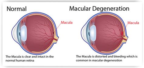 Macular degeneration (AMD) | Chatswood Private Hospital