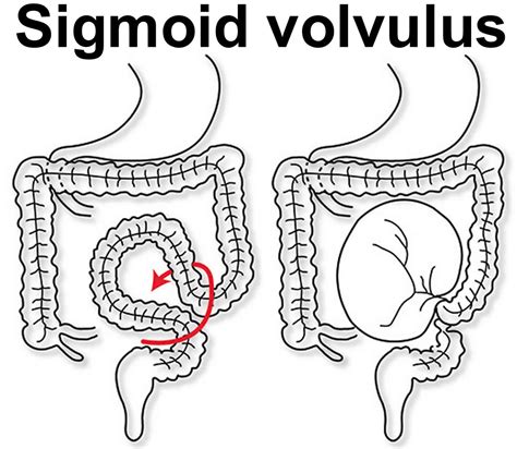 Sigmoid colon anatomy, location, function, polyps, diverticulosis & cancer