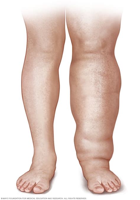 Lymphedema - Symptoms and causes - Mayo Clinic