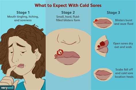 Cold Sore Outbreaks: Symptoms, Stages, Causes, Treatments