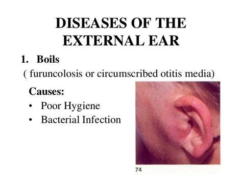 Boils( furuncolosis or