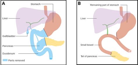 Consent: Whipple Procedure - Complications - Intraoperative ...