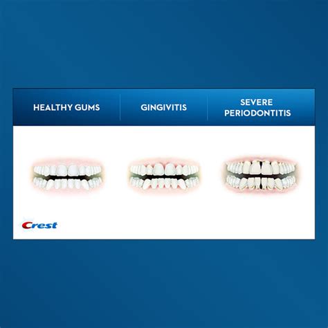 How To Restore Healthy Gums - Carpetoven2