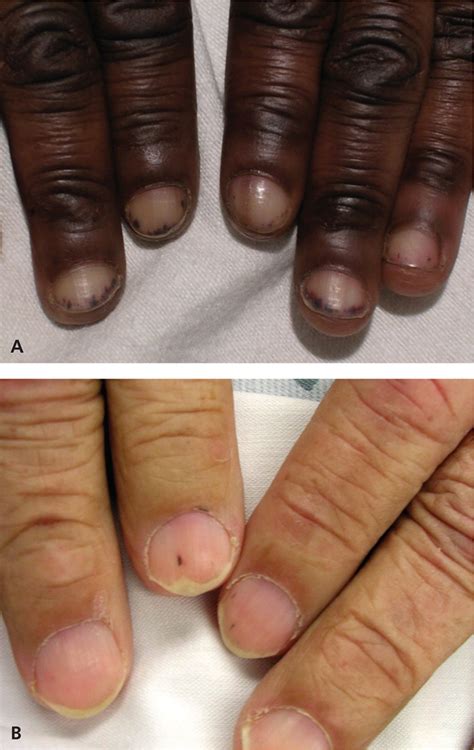 Fingernails - Ingrown fingernails - Dark Line - Fingernail Pain