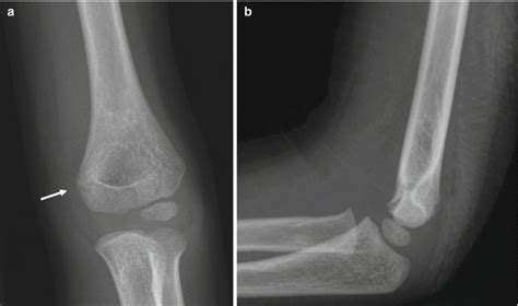 The Elbow and Forearm: Acquired Disorders | Radiology Key