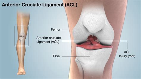 ACL Injury Shown and Explained Using 3D Medical Animation Still Shot