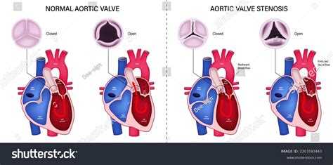 Difference Normal Aortic Valve Aortic Valve Stock Vector (Royalty Free ...