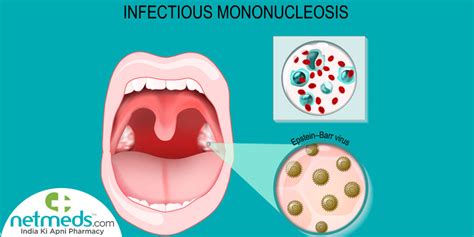 Mononucleosis: Causes, Symptoms And Treatment