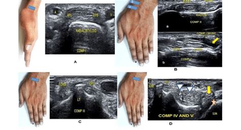 Ultrasound of the dorsal aspect of the wrist demonstrating extensor ...