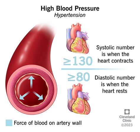 High Blood Pressure: Symptoms & Causes