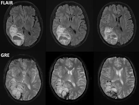 Acute Ischemic Stroke | Radiology Key