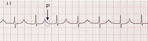 First Degree Heart Block • LITFL • ECG Library Diagnosis