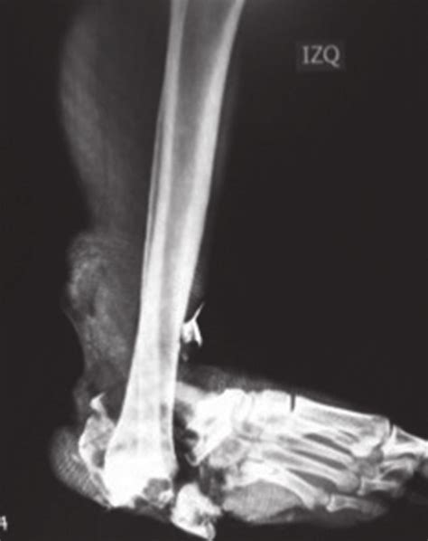 Leg Fracture X Ray