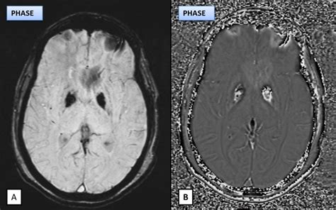 Basal ganglia calcification. Calcification is appearing hypointense on ...