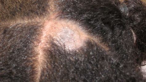 Why Do I Keep Getting Sores And Scabs On My Scalp - Infoupdate.org