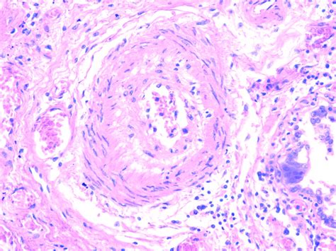 Pulmonary Hypertension Histology