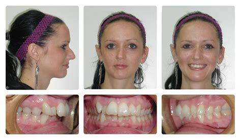 Orthodontic Before and After Photos | Brodsky Orthodontics