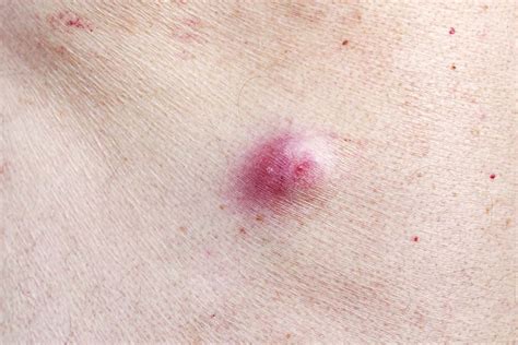 Epidermoid Cyst (EIC): Causes, Pictures & Removal