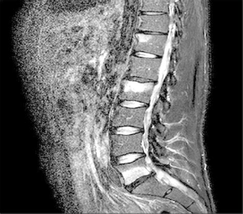 bone marrow edema sacroiliac joint treatment - stanovich-spillers