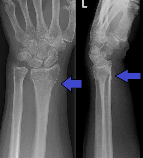 橈骨遠端骨折 Distal Radius Fracture: 最新的百科全書、新聞、評論和研究