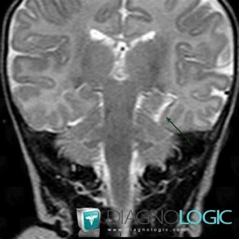 Radiology case : Cerebral infarction (MRI) - Diagnologic