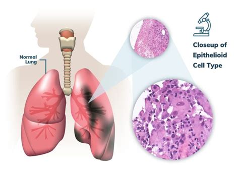 Pleural Mesothelioma | Treatment, Prognosis & Survival