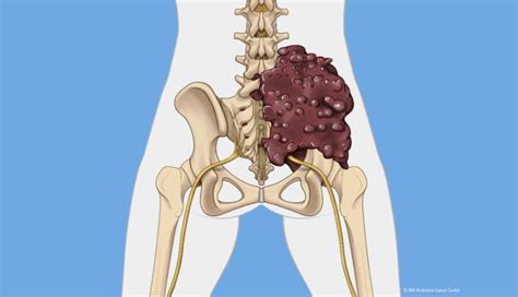 Understanding chondrosarcoma: symptoms, treatment and prognosis | MD ...