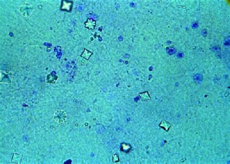 File:Calcium oxalate crystals in urine.jpg - Wikipedia