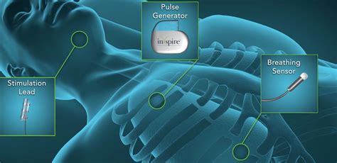 Implanted sleep apnea device promises safer, uninterrupted sleep ...