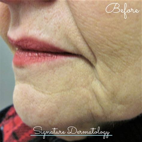 Marionette Lines Before and After | Signature Dermatology