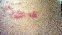 Herpes zoster - Wikipedia