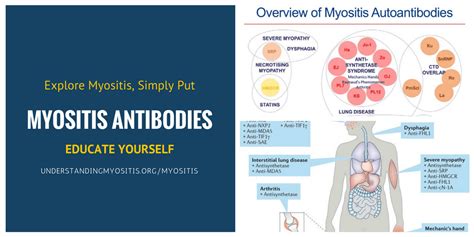 Myositis Specific Antibodies and Testing - Myositis Support and ...