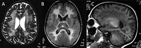 Metachromatic leukodystrophy: MRI in a 4-year-old child with normal ...