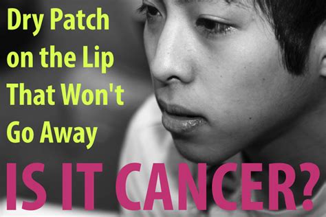 Dry Patch on the Lip That Won't Go Away: Is It Lip Cancer? | Cancer ...