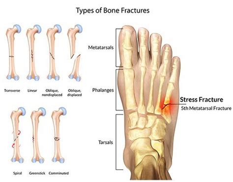 Stress Fractures of the Feet - The Foot and Ankle Clinic