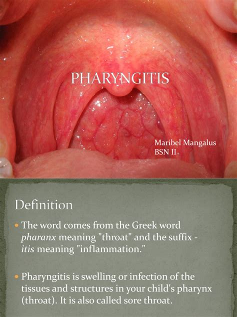 Pharyngitis Tonsilitis | Public Health | Medical Specialties