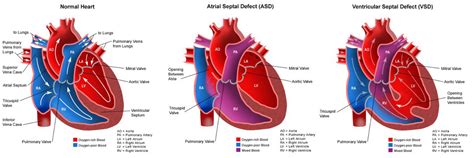 Congenital: Types Of Congenital Heart Defects